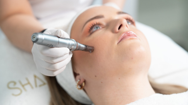 microneedling